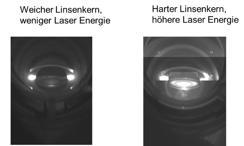 Automatische Individualisierung der Laserenergie nach Linsenhärte
